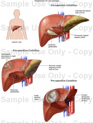 Liver Abscess Treatment